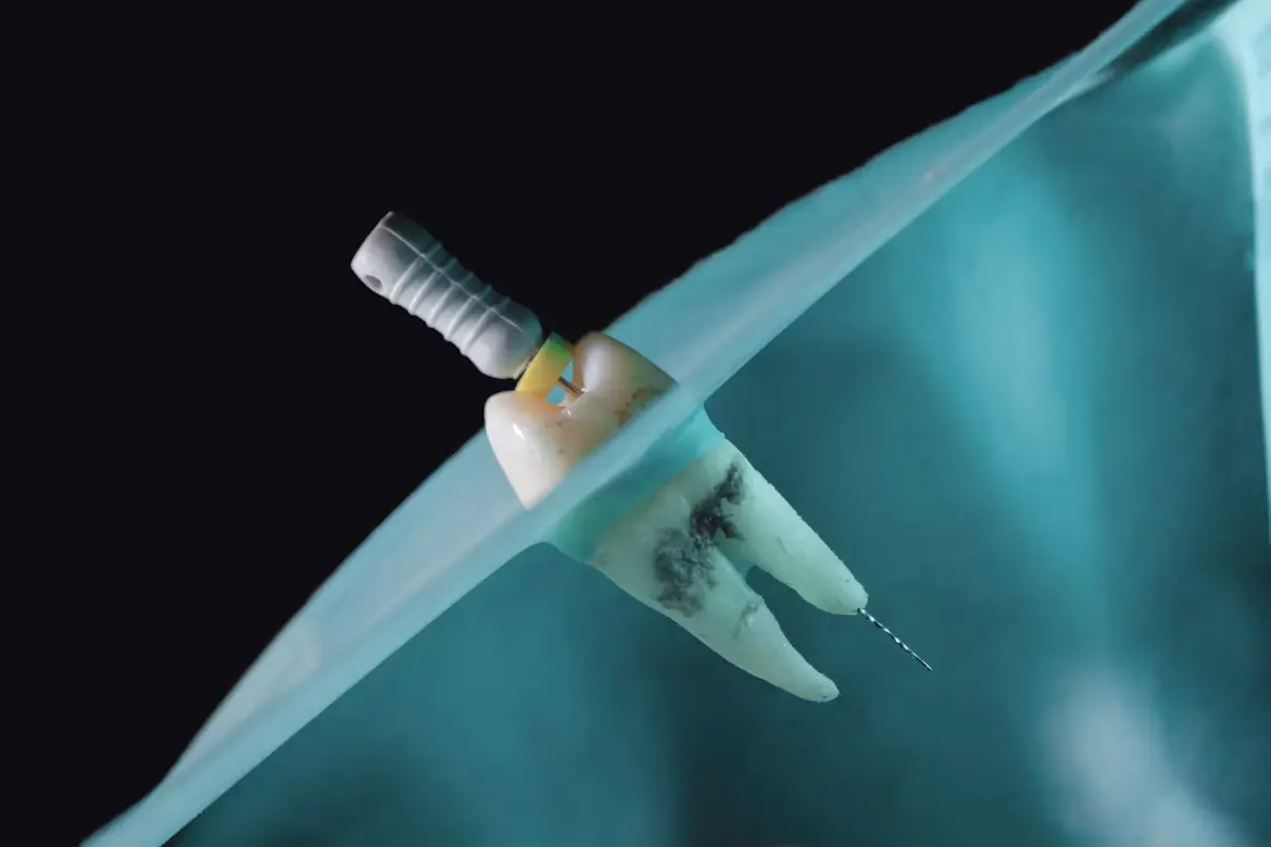 Tratamiento de conducto de endodoncia realizado en consultorio odontológico de Ingeniero Maschwitz y Escobar