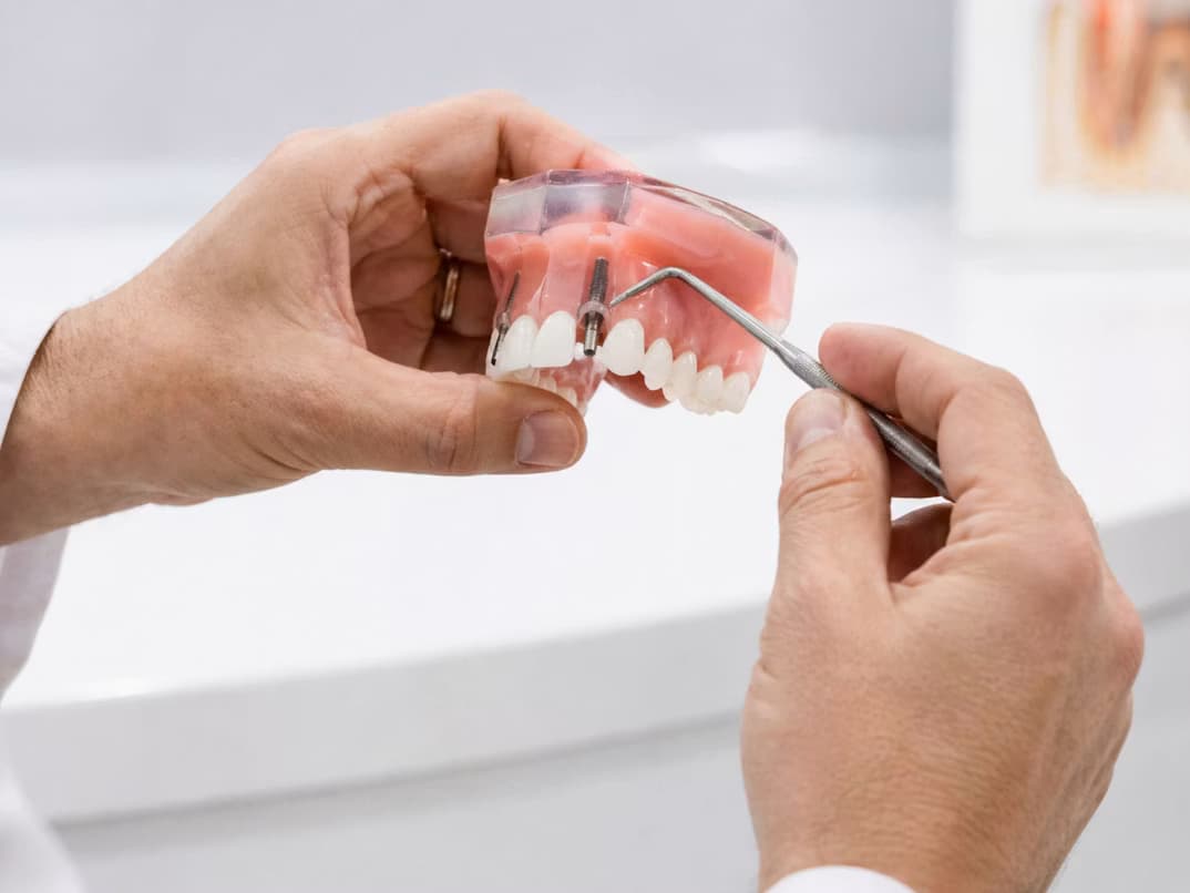 Colocación de implantes dentales en consultorio odontológico de Ingeniero Maschwitz y Escobar